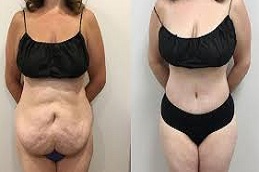 شد البطن المحيطي في دبي وأبوظبي والشارقة والعين