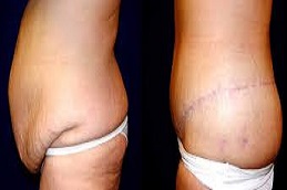 شد البطن المحيطي في دبي وأبوظبي والشارقة والعين