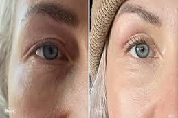 شد العين بواسطة بيكسلر البلازما في دبي