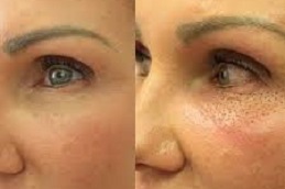 شد العين بواسطة بيكسلر البلازما في دبي