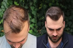 زراعة الشعر الهجين في دبي وأبوظبي والشارقة والعين