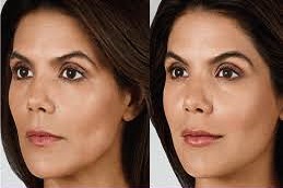 أليرجان بوتوكس في دبي أليرجان بوتوكس في دبي، أبو ظبي