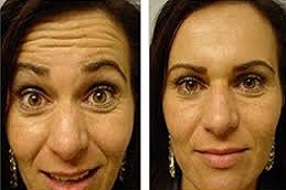 أليرجان بوتوكس في دبي أليرجان بوتوكس في دبي، أبو ظبي