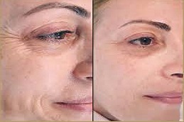 أليرجان بوتوكس في دبي أليرجان بوتوكس في دبي، أبو ظبي