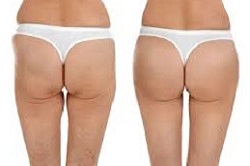 شد المؤخرة بالطريقة البرازيلية دبي وأبو ظبي والشارقة والعين