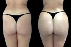 شد المؤخرة بالطريقة البرازيلية دبي وأبو ظبي والشارقة والعين