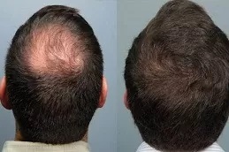 علاج الصلع الفعال للرجال في دبي وأبو ظبي والشارقة والعين