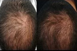 علاج الصلع الفعال للرجال في دبي وأبو ظبي والشارقة والعين