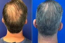 علاج الصلع الفعال للرجال في دبي وأبو ظبي والشارقة والعين