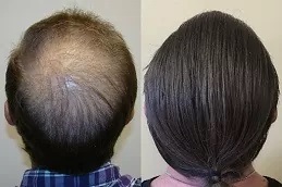 علاج الصلع الفعال للرجال في دبي وأبو ظبي والشارقة والعين