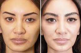 زراعة شعر الحواجب في دبي وأبوظبي والشارقة والعين