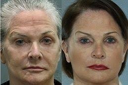 جراحة شد الوجه في دبي وأبو ظبي والشارقة والعين