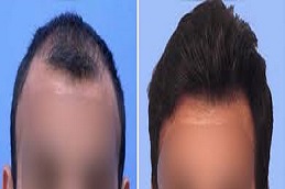 زراعة وحدات الشعر FUT في دبي وأبوظبي