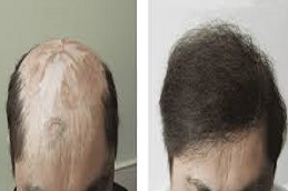 زراعة وحدات الشعر FUT في دبي وأبوظبي