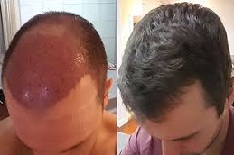 زراعة وحدات الشعر FUT في دبي وأبوظبي