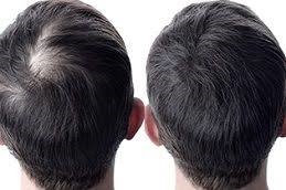 علاج GFC للشعر في دبي وأبوظبي والشارقة والعين