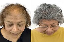 زراعة الشعر للإناث في دبي وأبوظبي والشارقة والعين