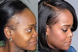 زراعة الشعر للإناث في دبي وأبوظبي والشارقة والعين