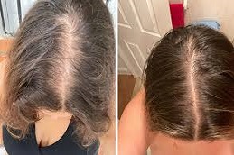 زراعة الشعر للإناث في دبي وأبوظبي والشارقة والعين