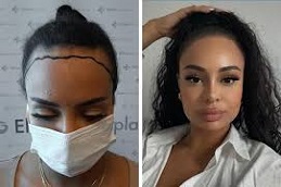 زراعة الشعر للإناث في دبي وأبوظبي والشارقة والعين