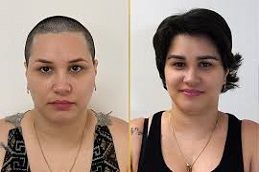 زراعة الشعر للإناث في دبي وأبوظبي والشارقة والعين
