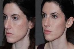 تحديد خط الفك خط الفك في دبي وأبو ظبي والشارقة والعين