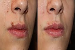 علاج إزالة الوحمات في دبي وأبو ظبي والشارقة والعين