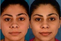 علاج إزالة الوحمات في دبي وأبو ظبي والشارقة والعين