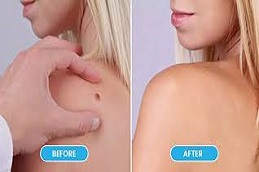 علاج إزالة الوحمات في دبي وأبو ظبي والشارقة والعين