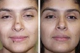 علاج إزالة الوحمات في دبي وأبو ظبي والشارقة والعين