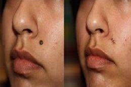 علاج إزالة الوحمات في دبي وأبو ظبي والشارقة والعين