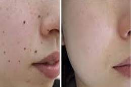 علاج إزالة الوحمات في دبي وأبو ظبي والشارقة والعين