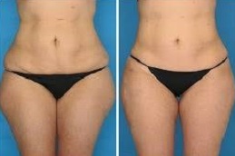 علاج ليبوماتيك، المتاح في دبي وأبو ظبي والشارقة والعين