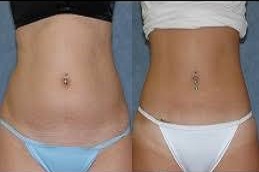 علاج ليبوماتيك، المتاح في دبي وأبو ظبي والشارقة والعين