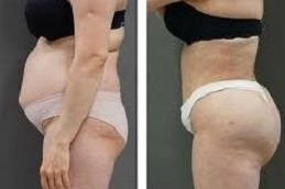 علاج ليبوماتيك، المتاح في دبي وأبو ظبي والشارقة والعين