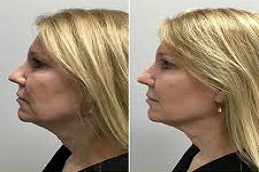 أفضل علاج  نفرتيتي في دبي وأبو ظبي والشارقة والعين