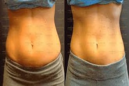 عملية نحت الجسم غير الجراحية في دبي وأبو ظبي والشارقة والعين