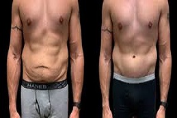 عملية نحت الجسم غير الجراحية في دبي وأبو ظبي والشارقة والعين