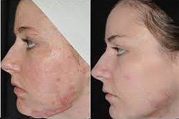 الجراحة الترميمية للحروق في دبي وأبو ظبي والشارقة والعين