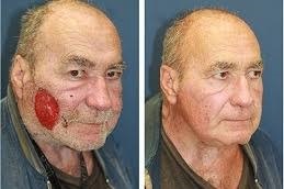 الجراحة الترميمية للحروق في دبي وأبو ظبي والشارقة والعين