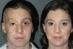 الجراحة الترميمية للحروق في دبي وأبو ظبي والشارقة والعين