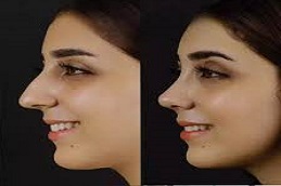 تجميل الأنف في دبي وأبو ظبي والشارقة والعين
