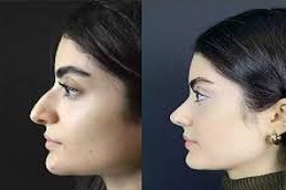تجميل الأنف في دبي وأبو ظبي والشارقة والعين