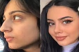 تجميل الأنف في دبي وأبو ظبي والشارقة والعين