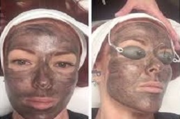 التقشير الكربوني بالليزر في دبي وأبو ظبي والشارقة والعين