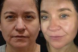 التقشير الكربوني بالليزر في دبي وأبو ظبي والشارقة والعين