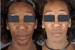 التقشير الكربوني بالليزر في دبي وأبو ظبي والشارقة والعين