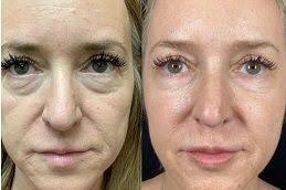 التقشير الكربوني بالليزر في دبي وأبو ظبي والشارقة والعين