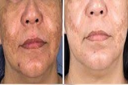 التقشير الكربوني بالليزر في دبي وأبو ظبي والشارقة والعين