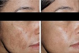 التقشير الكربوني بالليزر في دبي وأبو ظبي والشارقة والعين